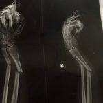 Keluarga Minta Polresta Tangkap Pelaku, Remaja di Pontianak Di Serang OTK Hingga Patah Tangan